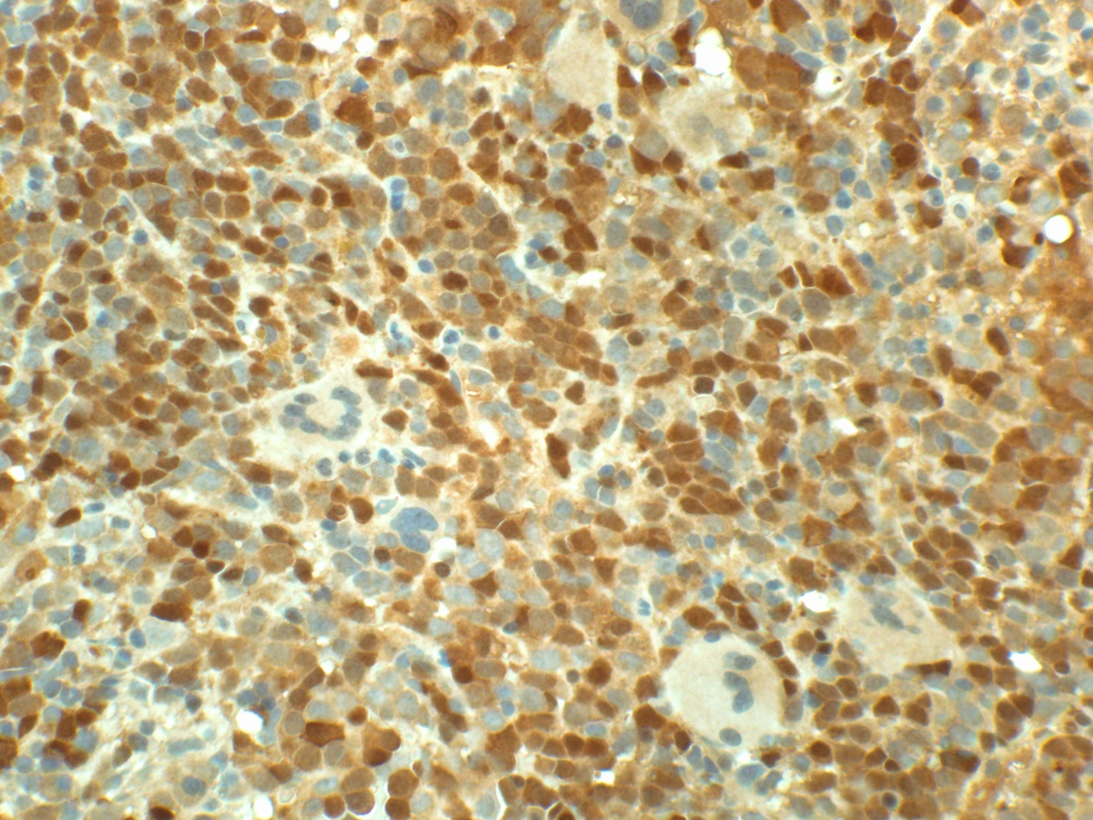 Hemoglobin A stain